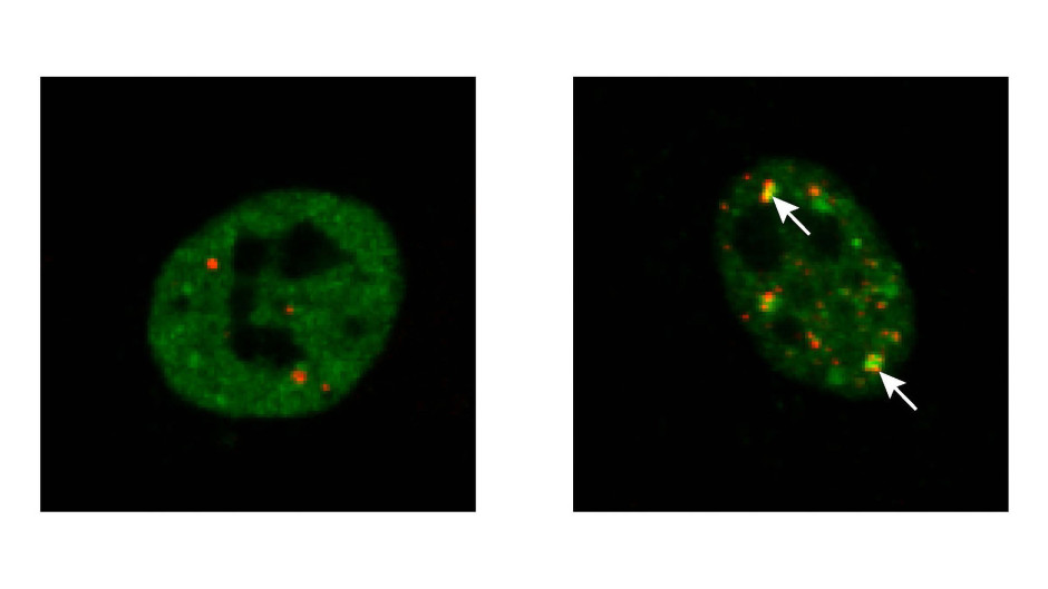 Die fluoreszenzmikroskopischen Aufnahmen zeigen Kerne kultivierter menschlicher Zellen: Links ist das Protein TDP 43 (grün) sichtbar verteilt im Zellkern gemeinsam mit Kernkörperchen (rot), die als Reparaturwerkstätten fungieren. Ist durch Stress oder Mutationen geschädigtes TDP-43 mit SUMO-Proteinen gekoppelt (rechtes Bild), wird es zu den Kernkörperchen transportiert (Pfeile) und so vor Verklumpung geschützt (Aufnahme: Dr. Jan Keiten-Schmitz).
